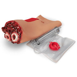 Lower Arm Amputation